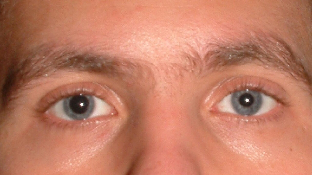 Отсутствие реакции зрачка на свет. Сужение и расширение зрачка. Исследование зрачка на свет. Глаза не реагируют. Отсутствие реакции зрачка на свет.